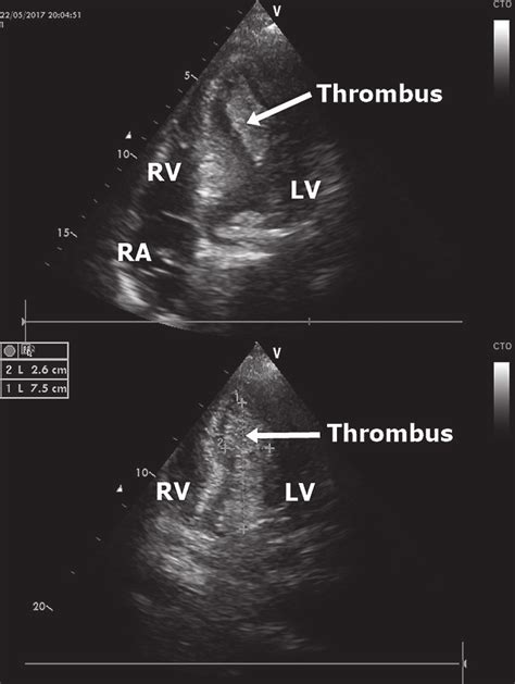 lv thrombus vs demonstrable lv thrombus